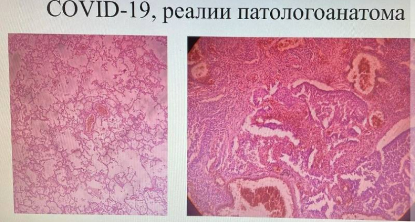 Усольский патологоанатом рассказала о пораженных коронавирусом легких