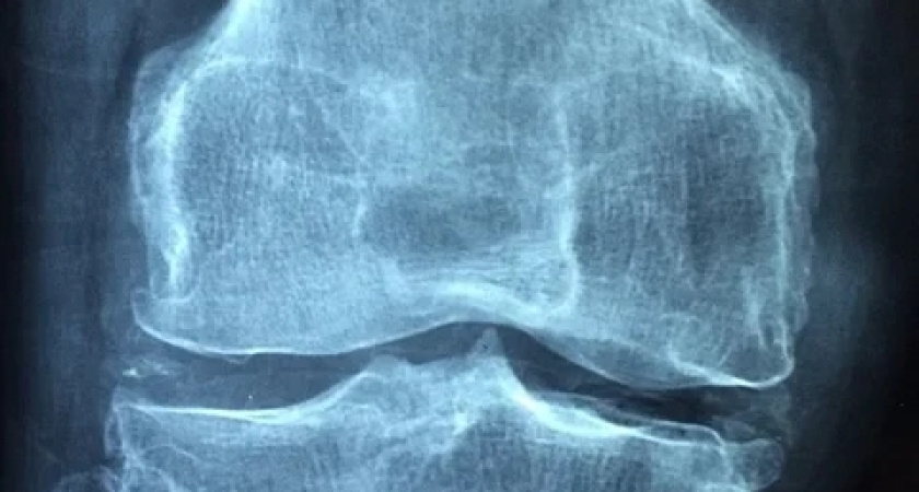 Daily Express: боль в ногах может говорить о высоком уровне холестерина